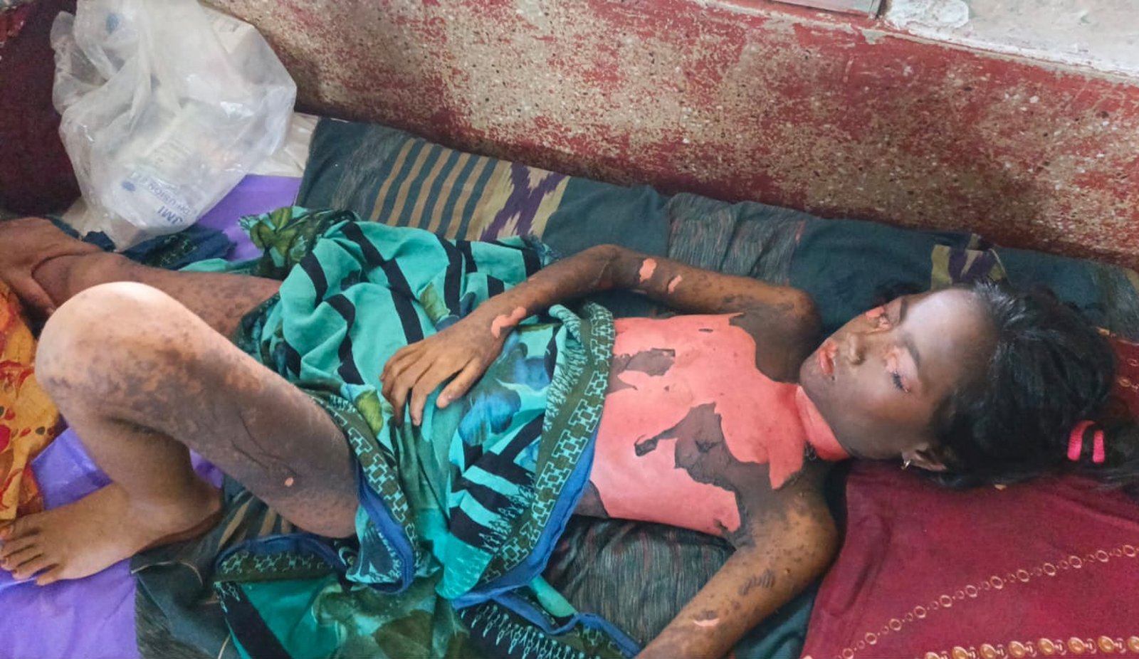হাতুড়ে পল্লী চিকিৎসকের ভুল চিকিৎসায় সারা শরীরে ক্ষত নিয়ে হাসপাতালে কাতরাচ্ছে শিশু নুরজাহান