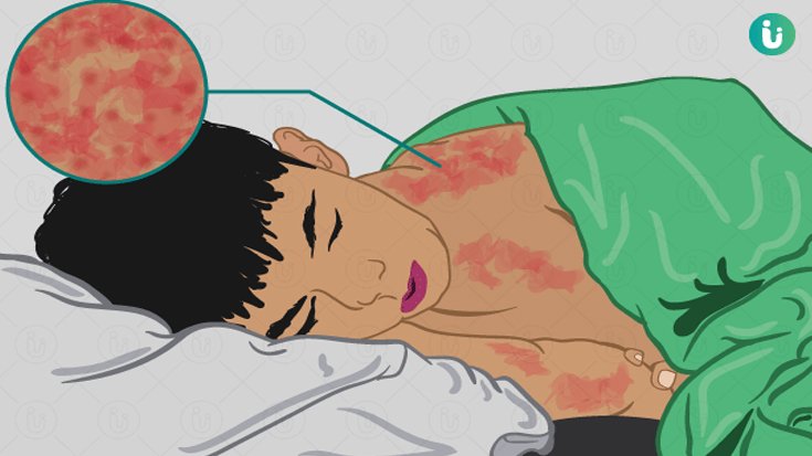 কীভাবে হাম ছড়ায় এবং লক্ষণ কী