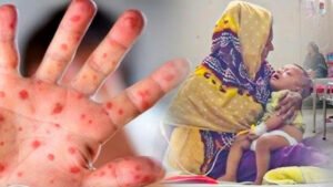 যে ৬ ধরনের খাবারে দ্রুত সেরে উঠবে হাম