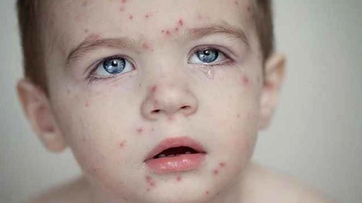 হাম উপসর্গে আরও ২ শিশুর মৃত্যু