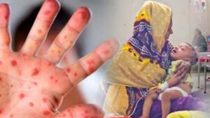 হাম ও হামের উপসর্গ নিয়ে আরও ১০ শিশুর মৃত্যু