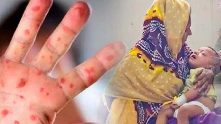 হাম কবে থেকে কমতে পারে