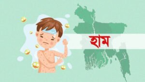 হামের উপসর্গ নিয়ে ৫ শিশুর মৃত্যু