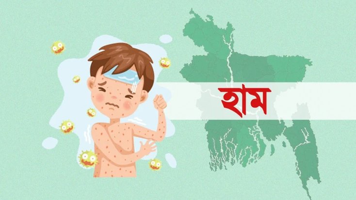 হামের উপসর্গ নিয়ে ৫ শিশুর মৃত্যু