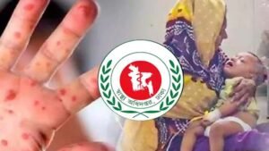 হামের উপসর্গে আরও ৯ শিশুর মৃত্যু