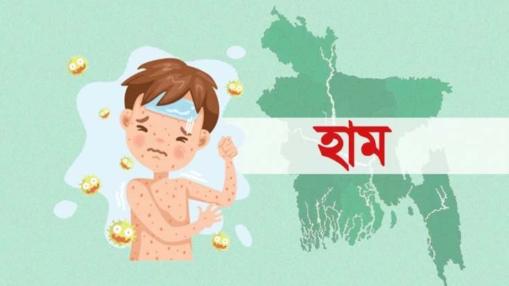 হাম ও হামের উপসর্গ নিয়ে আরও ৪ শিশুর মৃত্যু