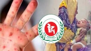 হাম ও হামের উপসর্গে ৩ শিশুর মৃত্যু, আক্রান্ত ১০৩২