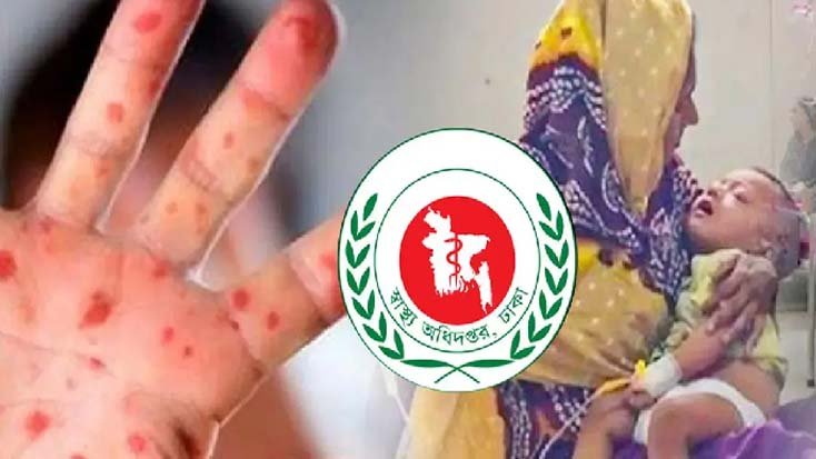 হাম ও হামের উপসর্গে ৩ শিশুর মৃত্যু, আক্রান্ত ১০৩২