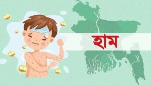 হাম ও হামের উপসর্গ নিয়ে আরও ৫ শিশুর মৃত্যু, আক্রান্ত ৯৬৯