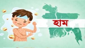 সারাদেশে হামের উপসর্গ নিয়ে ৪ শিশুর প্রাণহানি